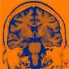 人工智能控制的大脑植入物用于测试人的情绪障碍